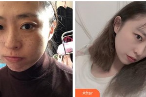 衡水天宏醫(yī)療美容醫(yī)院賈義娜整形價(jià)格表附激光祛斑案例展示