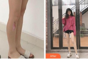 衡水瑞美醫(yī)療美容門診部杜軼男整形價(jià)格表附激光祛疤案例展示