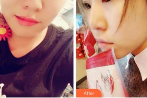 衡水愛爾眼科醫(yī)院姚艷整形價(jià)格表附切開雙眼皮案例展示