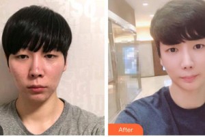 衡水愛爾眼科醫(yī)院賈艷青整形價(jià)格表附眼部修復(fù)案例展示