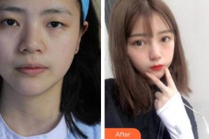 衡水愛爾眼科醫(yī)院趙勇整形價(jià)格表附切開雙眼皮案例展示