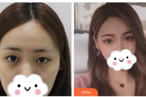 衡水顏美醫(yī)療美容診所馬建華整形價(jià)格表附眼部綜合案例展示