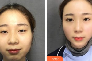 山西武警總醫(yī)院醫(yī)學(xué)整形美容中心季官學(xué)整形價格表附眼部綜合案例展示