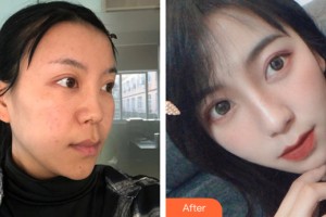 哈爾濱悠然醫(yī)療美容門診部曹思佳整形價格表附鼻部手術(shù)案例展示