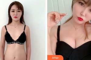 山西醫(yī)科大學(xué)附屬第一醫(yī)院激光整形美容中心王秀延整形價格表附自體脂肪隆胸案例展示