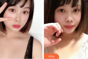 山西立仁激光整形醫(yī)院郭曉蓉整形價格表附自體脂肪隆胸案例展示