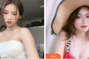 山西立仁激光整形醫(yī)院趙曉萌整形價格表附自體脂肪隆胸案例展示