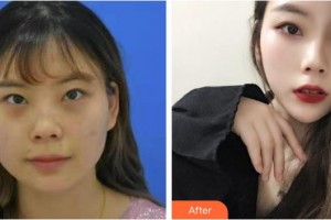 山西伊特雅整形美容門診部凌霄志整形價格表附E光嫩膚案例展示