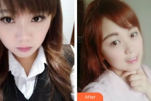 哈爾濱麗珍醫(yī)療美容醫(yī)院崔仁碩整形價格表附牙齒矯正案例展示