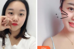 山西醫(yī)科大學(xué)第二醫(yī)院整形科梁炳整形價格表附去痘印痘坑案例展示