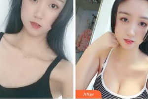 山西武警總醫(yī)院醫(yī)學(xué)整形美容中心張冀滿整形價格表附自體脂肪隆胸案例展示