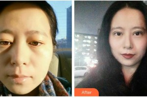 山西醫(yī)科大學(xué)第二醫(yī)院整形科郝敏整形價格表附祛斑祛痣案例展示