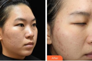 山西醫(yī)科大學(xué)附屬太鋼總醫(yī)院燒傷整形中心郝文杰整形價格表附清潔祛痘案例展示