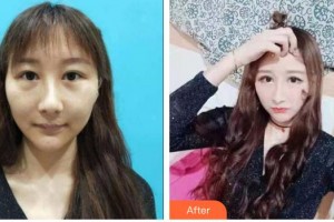 山西立仁激光整形醫(yī)院史炳炎整形價格表附光子嫩膚案例展示