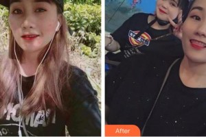 山西立仁激光整形醫(yī)院王姝整形價格表附去痘印痘坑案例展示