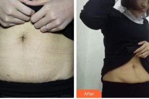 山西立仁激光整形醫(yī)院韓宏芳整形價格表附祛妊娠紋案例展示