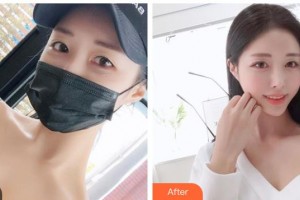 山西省整形外科醫(yī)院王德寧整形價格表附光子嫩膚案例展示