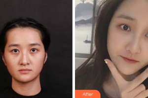 蘭州黛美爾醫(yī)學(xué)美容醫(yī)院任文明整形價格表附自體脂肪填充案例展示