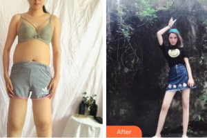 蘭州華美整形美容醫(yī)院謝大明整形價(jià)格表附大腿吸脂案例展示