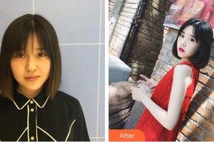 山西省整形外科醫(yī)院高振欣整形價格表附無針水光案例展示