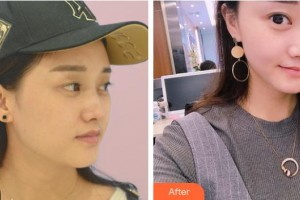 山西省眼科醫(yī)院張麗軍整形價格表附定點雙眼皮案例展示