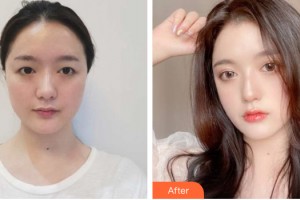 蘭州明倫醫(yī)療美容門(mén)診部張亞潔整形價(jià)格表附眼部手術(shù)案例展示
