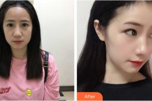 蘭州軍區(qū)烏魯木齊總醫(yī)院光子美容整形中心郭云整形價(jià)格表附植發(fā)案例展示