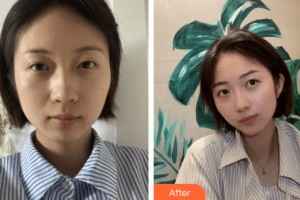 蘭州三愛(ài)整形美容醫(yī)院洪基錫整形價(jià)格表附皮膚美容案例展示