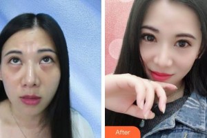 山西省眼科醫(yī)院朱曉弘整形價格表附切開雙眼皮案例展示
