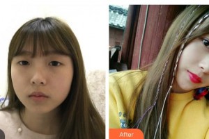 山西省眼科醫(yī)院張魏魏整形價格表附定點雙眼皮案例展示