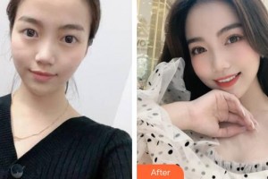 山西省眼科醫(yī)院曹偉芳整形價格表附切開雙眼皮案例展示