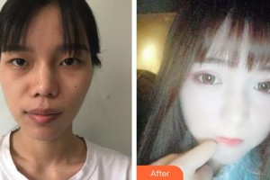 山西省眼科醫(yī)院王瑞姝整形價(jià)格表附眼部綜合案例展示