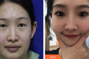 山西省眼科醫(yī)院王海濤整形價格表附定點(diǎn)雙眼皮案例展示