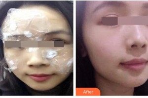 太原解放軍264醫(yī)院美容整形中心劉勁燕整形價(jià)格表附祛斑祛痣案例展示