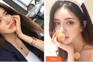 太原華美整形美容醫(yī)院吳強(qiáng)整形價(jià)格表附激光去紋身案例展示