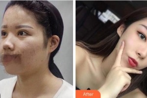 太原銀澤醫(yī)療美容門診部白愛國整形價(jià)格表附鼻部綜合案例展示