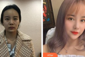 太原華美整形美容醫(yī)院李國玲整形價(jià)格表附鼻部綜合案例展示