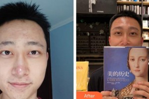 太原顯微手外科醫(yī)院毛發(fā)移植中心謝祥整形價(jià)格表附種眉毛案例展示