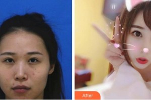 太原美之妍醫(yī)療美容診所曹立銘整形價(jià)格表附鼻部綜合案例展示