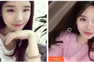 太原麗都整形美容醫(yī)院楊婧媛整形價(jià)格表附激光祛斑案例展示