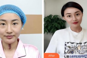 太原歐美蓮整形美容醫(yī)院姜泰燮整形價(jià)格表附去痘印痘坑例展示