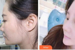 太原歐美蓮整形美容醫(yī)院張繁萍整形價(jià)格表附鼻部綜合案例展示