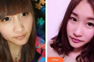 太原美雅楓（原裴世榮）整形美容醫(yī)院裴世榮整形價格表附膨體隆鼻案例展示