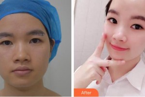 太原晉容整形美容門診部張步濤整形價格表附埋線提升案例展示