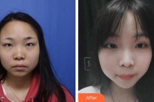 太原青松醫(yī)療美容門診部馮光整形價格表附埋線提升案例展示