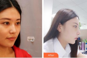 太原美萊整形醫(yī)院金大原整形價(jià)格表附光子嫩膚案例展示