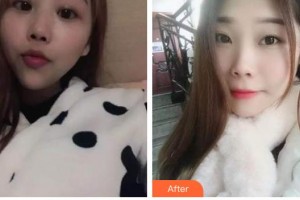 太原歐美蓮整形美容醫(yī)院高歡利整形價格表附鼻部綜合案例展示