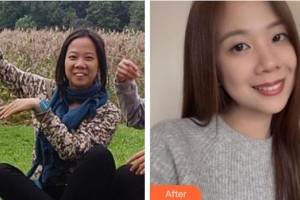 太原時(shí)光整形美容醫(yī)院白麗鵬整形價(jià)格表附金屬托槽矯正案例展示