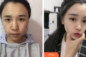 太原華美整形美容醫(yī)院岳輝整形價格表附激光祛斑案例展示