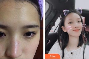 太原美之妍醫(yī)療美容診所冀慧霞整形價格表附激光祛斑案例展示